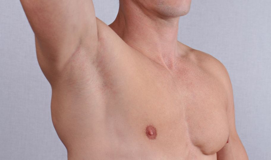 Коррекция гинекомастии