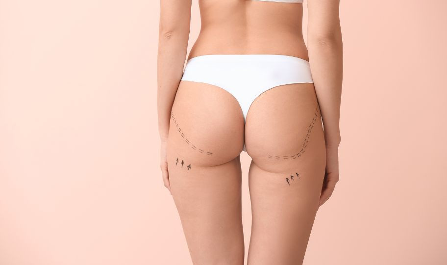 Липосакция в Минске