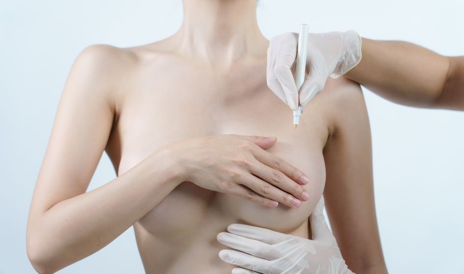 Пластика ареол груди
