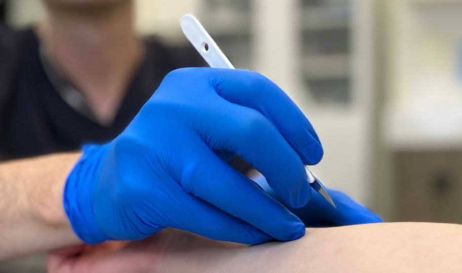 Удаление атеромы хирургическим методом