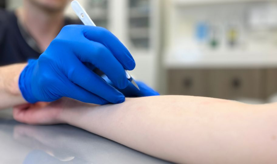 Удаление фибромы хирургическим методом