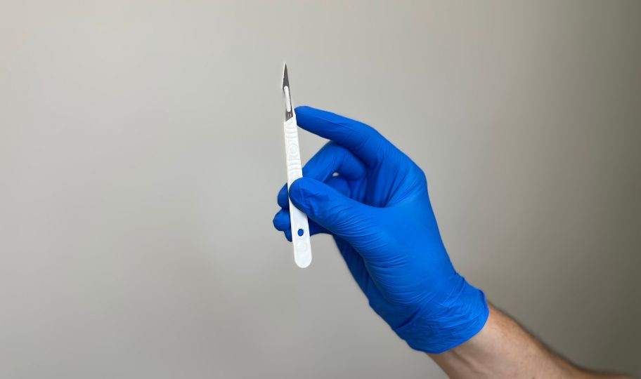 Удаление папилломы хирургическим методом