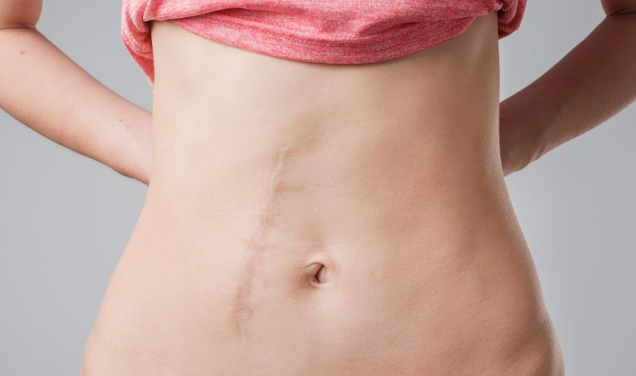 Удаление рубцов с пластикой местными тканями