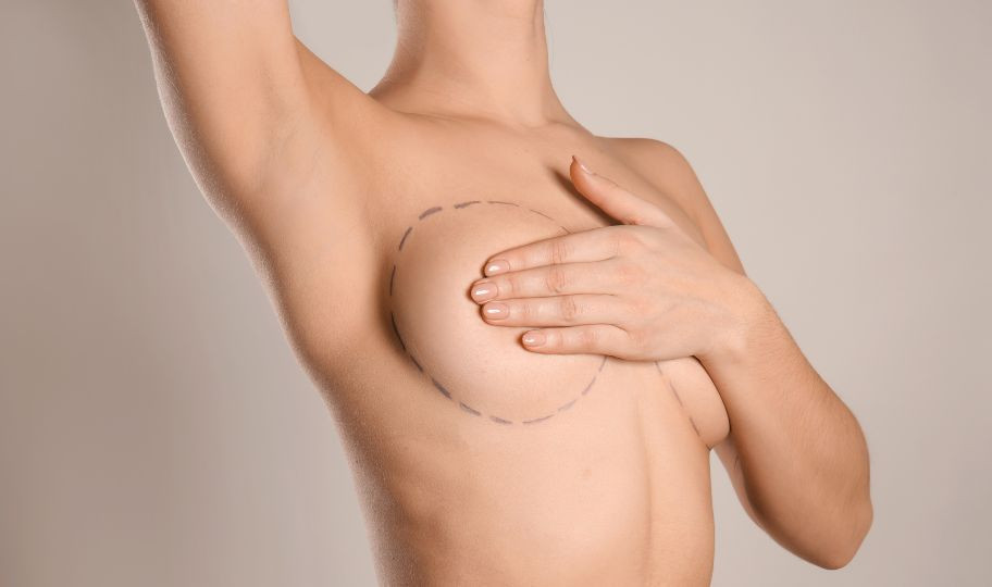 Подтяжка груди
