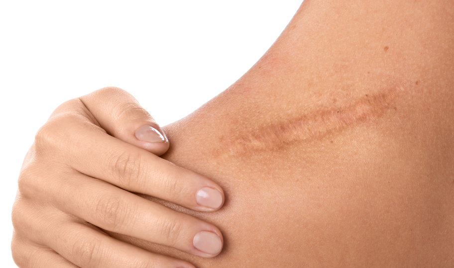 Удаление патологических рубцов тела с пластикой местными тканями (до 10 см)